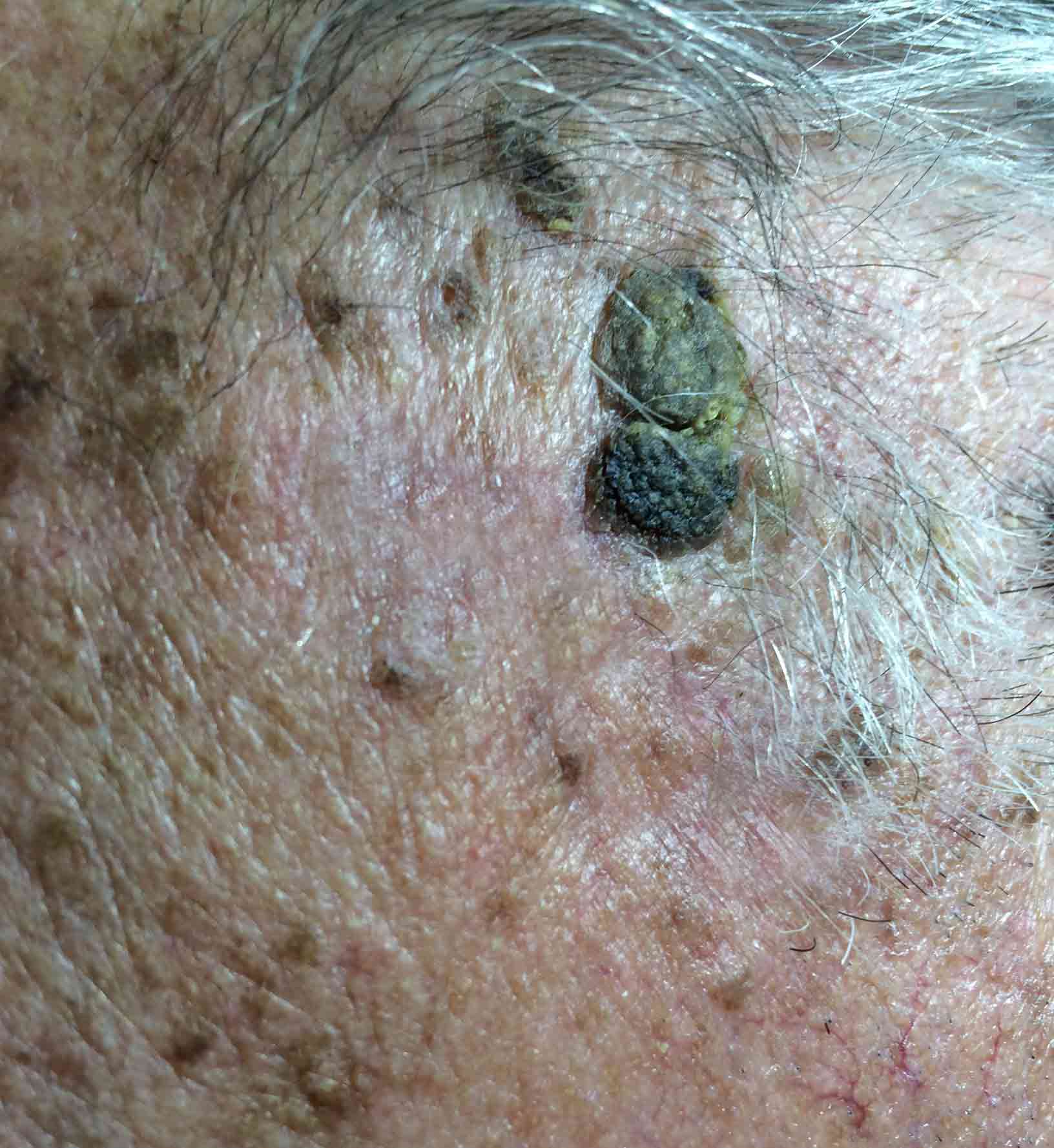 wart cancerous skin tags pictures