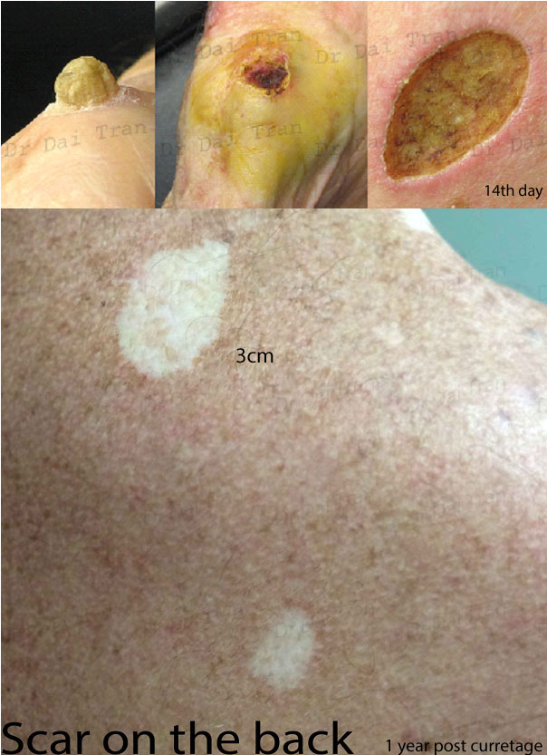 curretage-and-cautery-and-scar