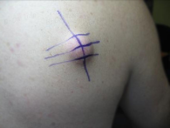cyst-on-back