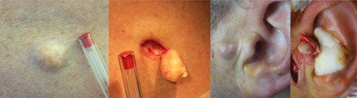 removal of cyst