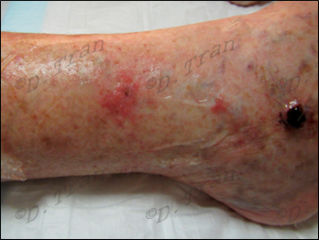 Venous leg ulcer. Skin cancer look a like.