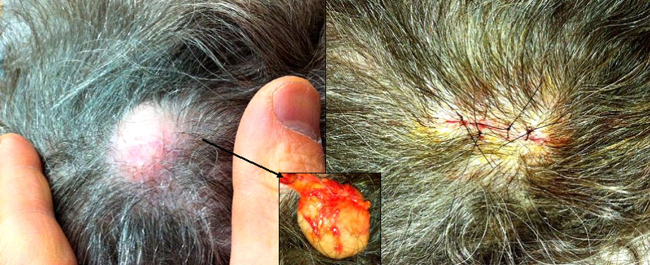 removal-cyst-scalp