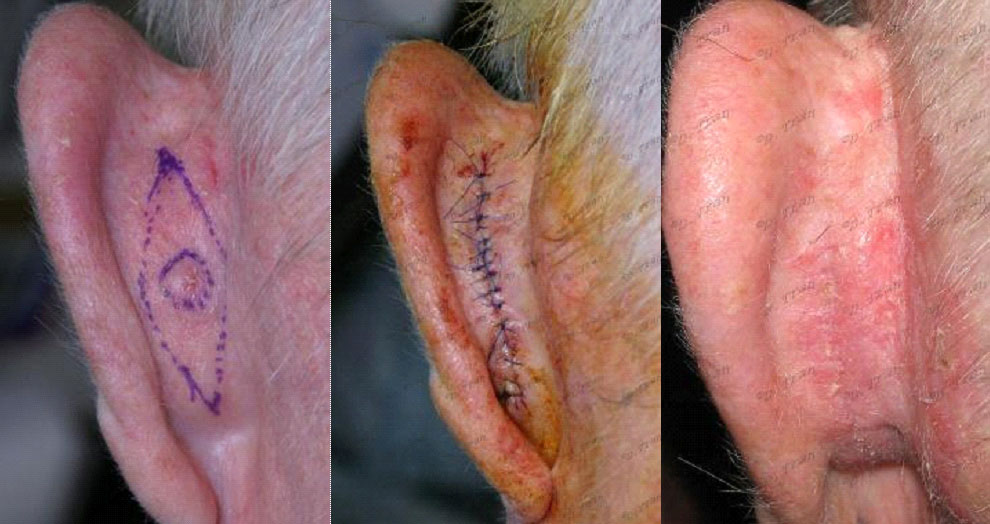 removal-skin-cancer-ear