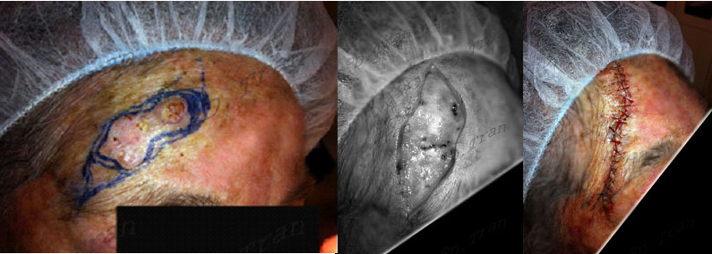 skin-cancer-scc-temple-removal
