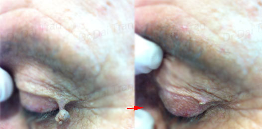 skin-tag-removal-on-eyelid