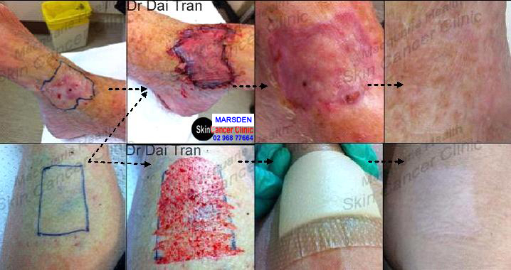 split thickness skin graft to ankle