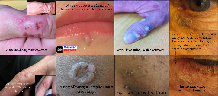 wart on lip,face,finger and body.