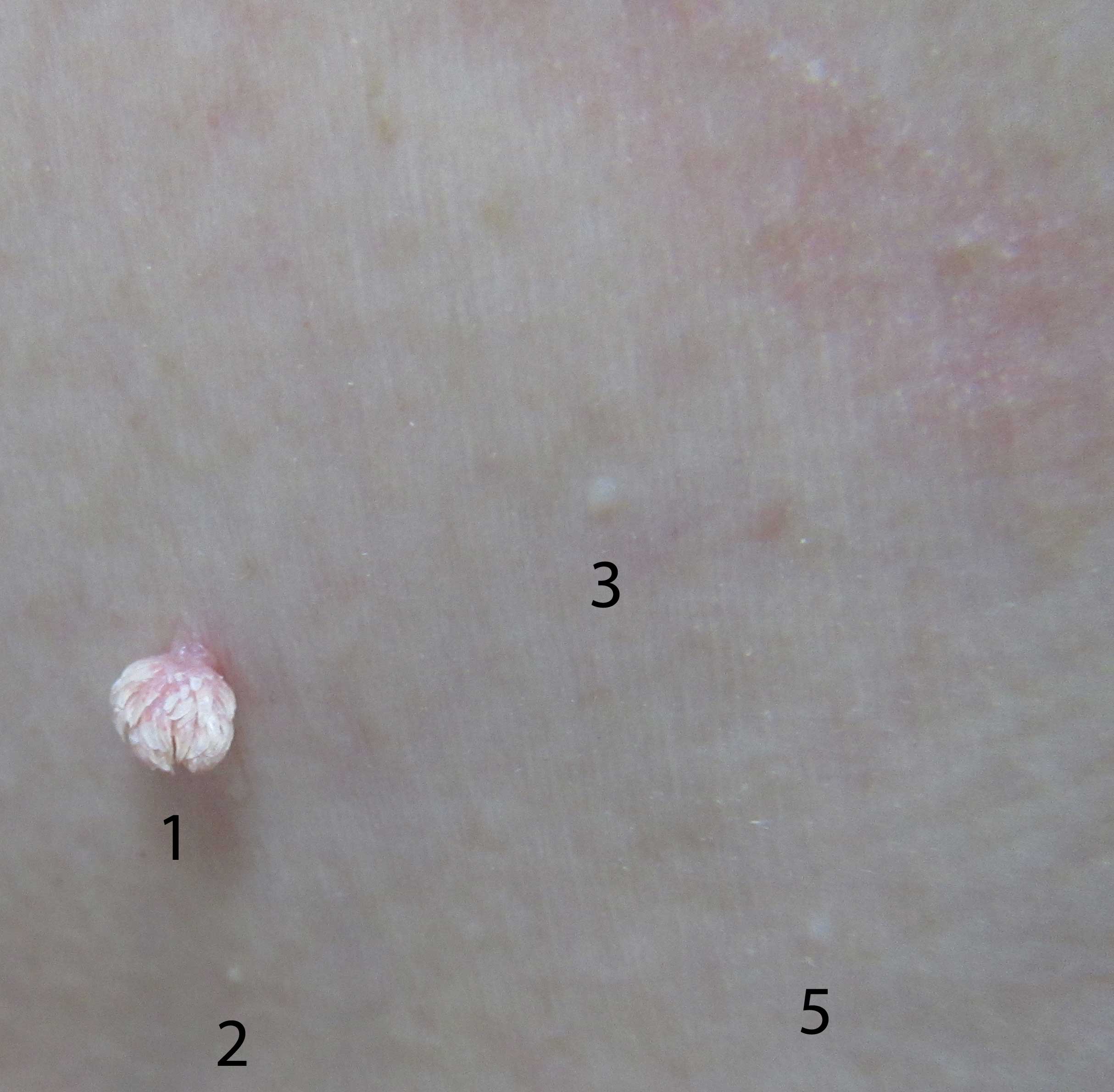 Multiple warts of varying sizes on the skin