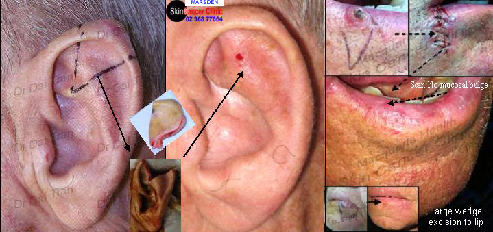 wedge excision to ear and lip