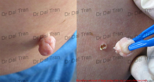 skin tag removal on body
